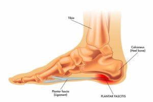 Plantar Fasciitis anatomical image of foot